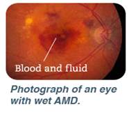 Wet AMD